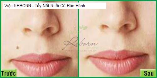 Bảng giá Viện REBORN - Tẩy Nốt Ruồi Có Bảo Hành